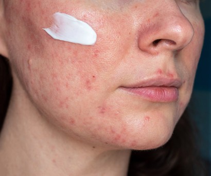 Ροδόχρους πιτυρίαση