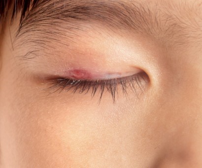 Σταφυλόκοκκος: Πόσο διαρκεί-Συμπτώματα-Θεραπεία