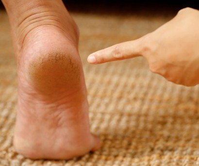 Αφαίρεση κάλων με φυσικό τρόπο