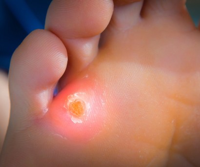 Το καλύτερο προϊόν για κάλους στα πόδια