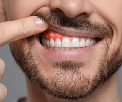 Ουλίτιδα και αλατόνερο: Λειτουργεί πραγματικά ως θεραπεία;