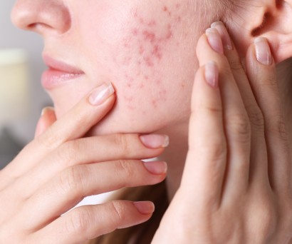 Σημάδια από ακμή: Πώς φεύγουν;