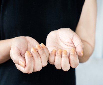 Αντιβιοτική κρέμα για φλεγμονή στο νύχι: Πότε και πώς να τη χρησιμοποι …