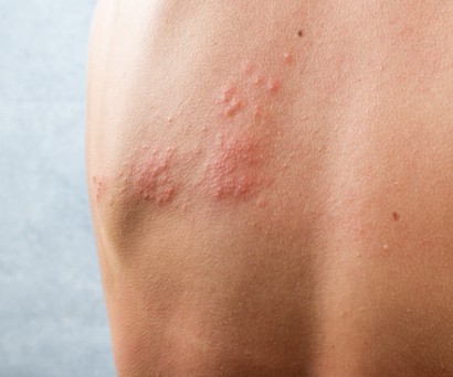 Έρπης Ζωστήρας: Αρχικά Συμπτώματα & Λύσεις