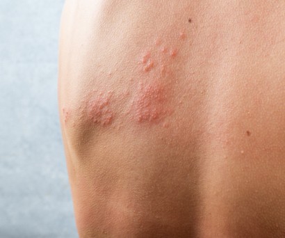 Έρπης ζωστήρας: Αρχικό στάδιο και πότε να επισκεφθείτε γιατρό