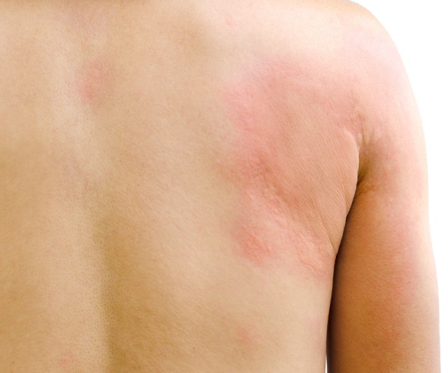 Τροφές που απαγορεύονται στην κνίδωση